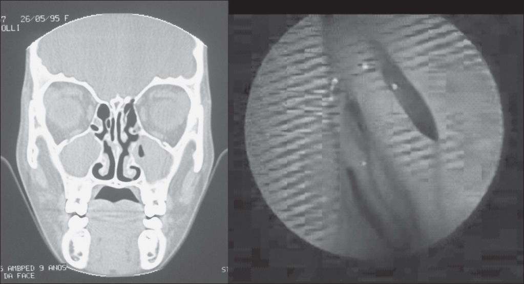 Diagnosis of chronic rhinosinusitis in patients with cystic fibrosis ...