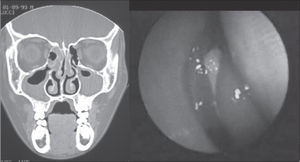 Example (case 12) of the agreement between results of assessments. CT scan and nasofibroscopy with positive diagnosis of chronic rhinosinusitis.