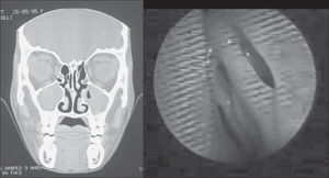 Example (case 5) of disagreement between the results of assessments. CT scan with positive diagnosis and nasofibroscopy with negative diagnosis of chronic rhinosinusitis.