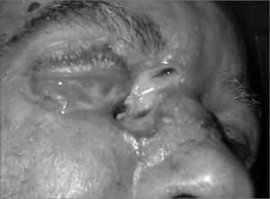 Nasal cavities myiasis with orbit complications.