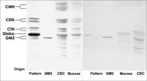 Orcinol/H2SO4 dyed HPTLC slide. (Left) and (right) resorcin dyed HPTLC - Pattern – erythrocyte GSL pattern. GM3 – GM3 Pattern (Sigma®). SCC – SCC GSL. Normal mucosa normal – normal mucosa GSL.