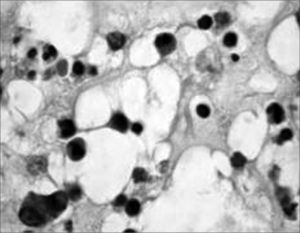Histology cross-section of an eosinophylic polyp. Stroma bearing eosinophils, lymphocytes and edema.