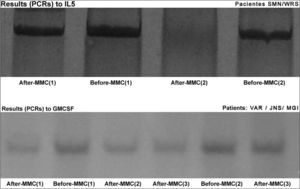 IL5 and GM-CSF PCR results before and after MMC.
