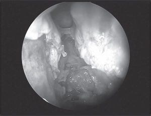 Presence of the anterior ethmoid canal in the nasal cavity crossing the ethmoidal labyrinth at more than 5mm away from the skull base (45 degree endoscope).