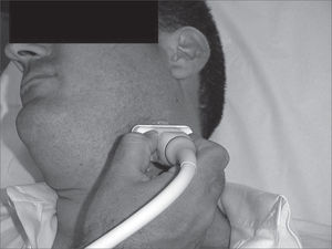 Transcutaneous US placed in the angle of the lower jaw with the patient in orthostatism and lateral rotation of the head.