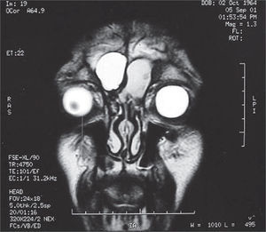 Magnetic resonance image of paranasal sinuses, coronal section, T2. Bilateral Frontal Mucocele.