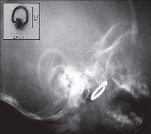 1a: radiologic exam showing a foreign body in the nasopharynx. 1b: curtain rail hook removed from the nasopharynx; observe the degree of oxidation of metal parts.