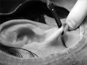 Photograph showing a longitudinal incision completing the earlobe cleft towards the lower border, splitting the lobe in 2 halves.