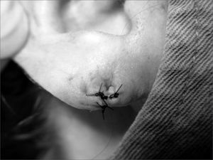 Photograph showing the final surgery outcome. We see the orifice for earring placement, totally epithelized.