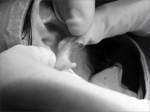 Photograph showing the earlobe split in two flaps.