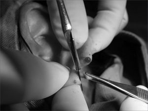 Photograph showing scraping o the anterior lobe flap.