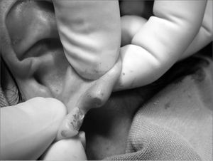Photograph showing anterior lobe flap with an open wound in the posterior face.