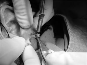 Photograph showing a longitudinal incision on the posterior lobe flap, of 2.0mm thickness, creating a new 5.0×2.0 flap.