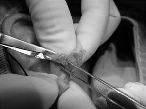 Photograph showing a cross 2.00 incision on the lower border of the central flap.
