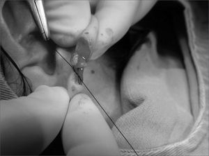 Photograph showing a central flap rotation in such a way as that the epithelized borders make the lobe orifice and mononylon 5-0 suturing.