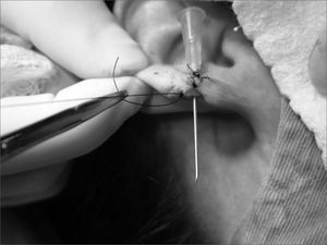 Photograph showing lobe flap suturing with 5-0 nylon and the needle in the final orifice for an earring placement.