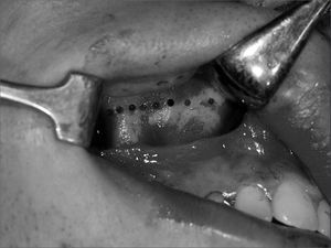 Osteotomy of the anterior and lateral maxillary walls.