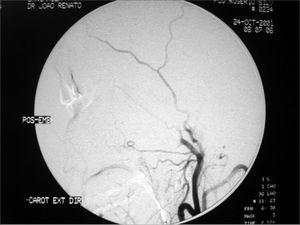 Post-embolization angiography - maxillary artery without tumor branches.