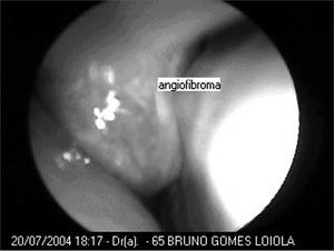 Nasofibroscopy showing the tumor in the right nasal cavity - angiofibroma in the center.