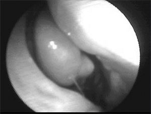 Post-operative nasofibroscopy - no tumor in the right nasal cavity.