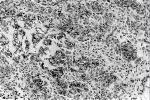 CK 14 expression in epithelioid and fusiform cells in small salivary gland myoepitheliomas (SABC, 200x).