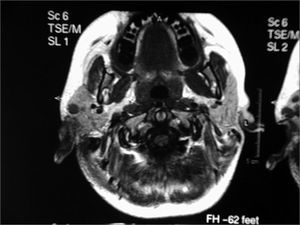 Magnetic resonance imaging of the cranium - presence of lesions in both temporal bones suggesting histiocytosis X.
