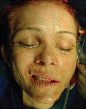 Photography showing right-side hemiface middle third elevation during the procedure.