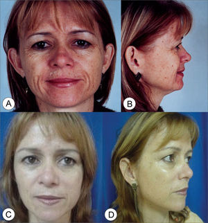 Frontal view (A) and side view (B) of a 47 year old female patient with enlarged nasolabial groove, relevant drop of malar prominence and mild jaw line ptosis. (C and D) Subperiosteal rhytidoplasty postoperative image (3 years) depicting malar prominence elevation, reduction in the nasolabial groove and jaw line improvement.