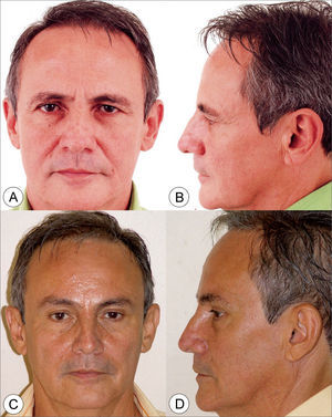 Frontal view (A) and side view (B) of a 52 year old male patient with enlarged nasolabial groove, relevant drop of malar prominence and moderate jaw line ptosis. (C and D) Subperiosteal rhytidoplasty and endoscopic frontoplasty postoperative image (2 years) depicting malar prominence elevation, reduction in the nasolabial groove and jaw line improvement.