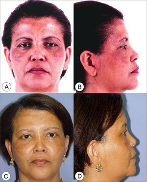 Frontal view (A) and side view (B) of a 45 year old female patient with enlarged nasolabial groove, moderate drop of malar prominence and moderate jaw line ptosis. (C and D) Subperiosteal rhytidoplasty and endoscopic frontoplasty postoperative image (1 year) depicting malar prominence elevation, reduction in the nasolabial groove and jaw line improvement.