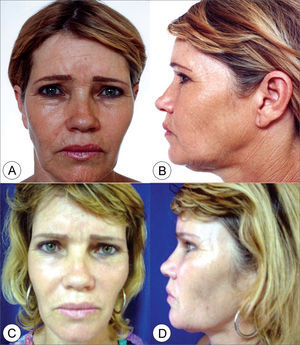 Frontal view (A) and side view (B) of a 51 year old female patient with moderately enlarged nasolabial groove, moderate drop of malar prominence and moderate jaw line ptosis. (C and D) Subperiosteal rhytidoplasty postoperative image (4 years) depicting malar prominence elevation, reduction in the nasolabial groove and jaw line improvement.
