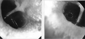 Radial tympanocentesis by microknife (left), and circular by argon laser (right).