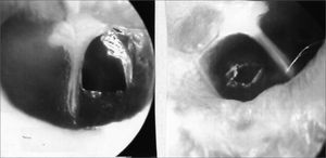 Broad tympanocentesis (left), and irregular by argon laser (right).