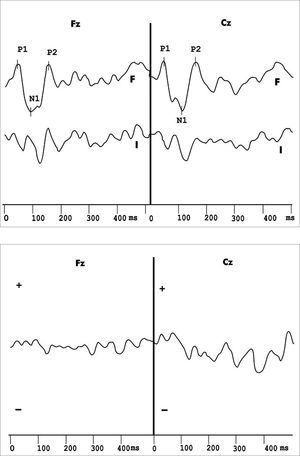 Exogenous long latency hearing evoked potentials recording and the difference wave obtained from frequent and infrequent stimuli, with no Mismatch Negativity in the duration variation protocol in the Multiple Sclerosis group.