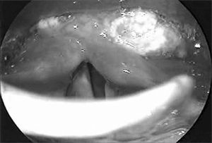 Tumor view at videolaryngoscopy: vegetating lesion involving mostly the left piriform cavity.