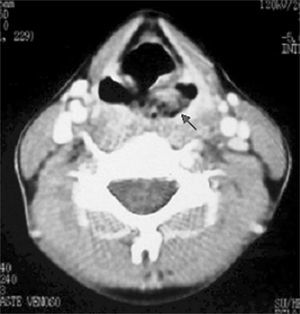 Neck CT scan, axial view: tumor mass in the left piriform cavity.
