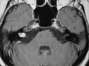 Skull MRI scan (axial T1 contrast-enhanced) showing right-side cavernous hemangioma.