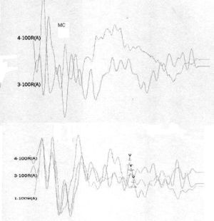 Following stimulus polarity inversion, cochlear microphonism (CM) appears; with a reduced stimulus frequency, wave V appears.