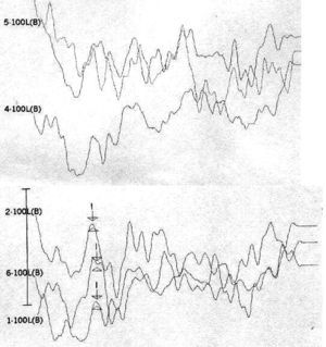 Following stimulus polarity inversion there is no cochlear microphonism (CM); with a reduced stimulus frequency, wave I appear.