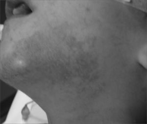 Chin dermatitis secondary to sialorrhea.