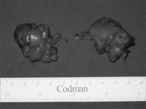 Excised right and left submandibular glands.