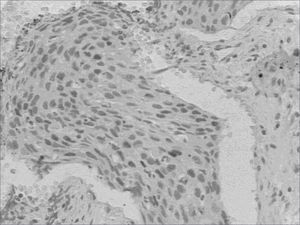 D1 cyclin expression - D1 cyclin expression dyed in Brown in the nucleus of neoplastic cells.