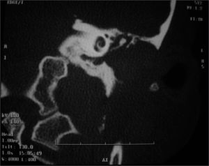 Temporal bone CT Scan - Left Ear.