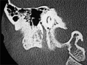 Coronal temporal bone CT scan, showing an image with soft tissue density, occupying and enlarging the third portion of the facial nerve, all the way to stylo-mastoid foramen.