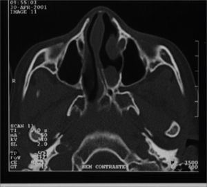 A case of left side choanal atresia and symmetrical maxillary sinuses and no sinus disease.