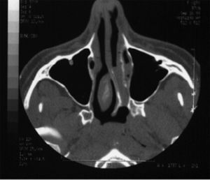 A case with CT scan characteristics similar to the one shown in Photo 1, left side choanal atresia, symmetrical maxillary sinuses and no sinus disease.