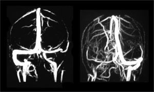 MR angiography showing two different cases of sigmoid sinus thrombosis. The left figure shows no flow in the right sigmoid sinus and the right side figure shows no flow in the left sinus, confirming the diagnosis of thrombosis.