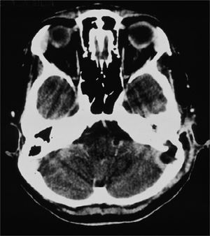 Skull CT scan with contrast, showing contrast highlight around the sigmoid sinus and lack of this highlight inside, with bone erosion to the posterior fossa.