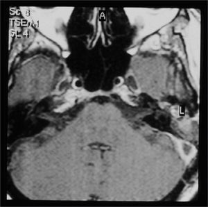 Temporal bone contrasted MRI, showing contrast highlight around the sigmoid sinus and no highlight inside, suggesting that there is a thrombus inside.