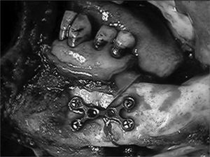 Mandibulotomy associated with marginal mandibulectomy in tonsillar region lesions.
